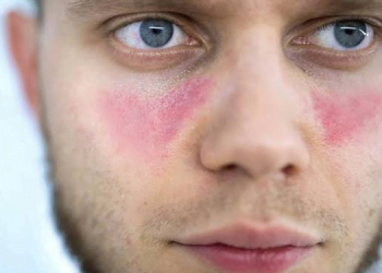 Bağışıklık Sisteminin Düşmanı: LUPUS 10 Bağışıklık Sisteminin Düşmanı: LUPUS