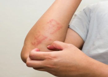 Alerjiyle Baş Etme 15 alerji nedir