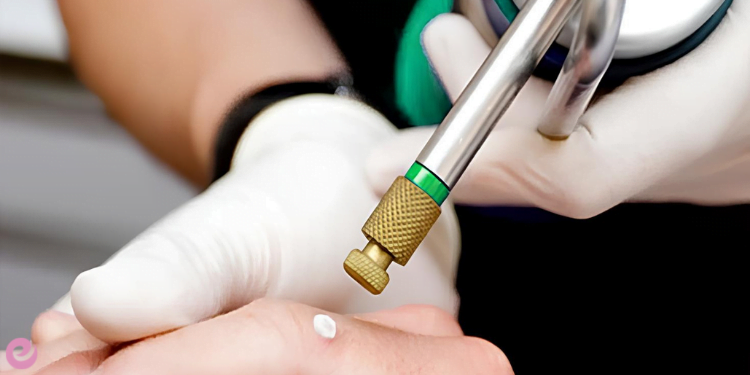 Kriyoterapi Nedir? Kriyoterapi Neden Yapılır? 1 Kriyoterapi Nedir? Kriyoterapi Neden Yapılır?